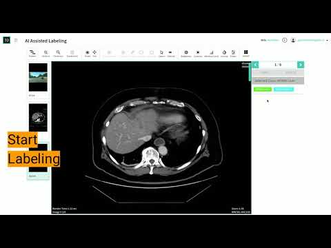 AI Assisted Liver Segmentation
