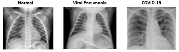 Image of CXR