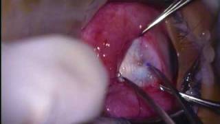 medial rectus squint surgery.mpg