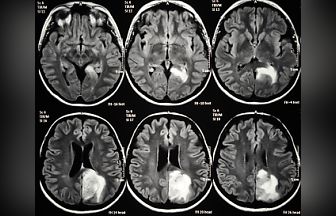 glioma_image