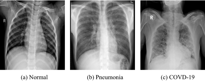 Example of Chest Radiography