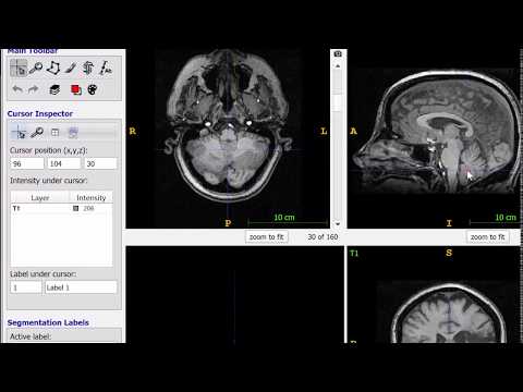 Lesion registration