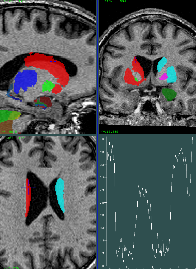 striatum 0