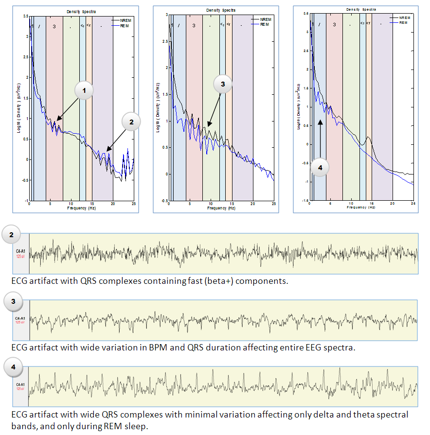 ECG Artifact Examples