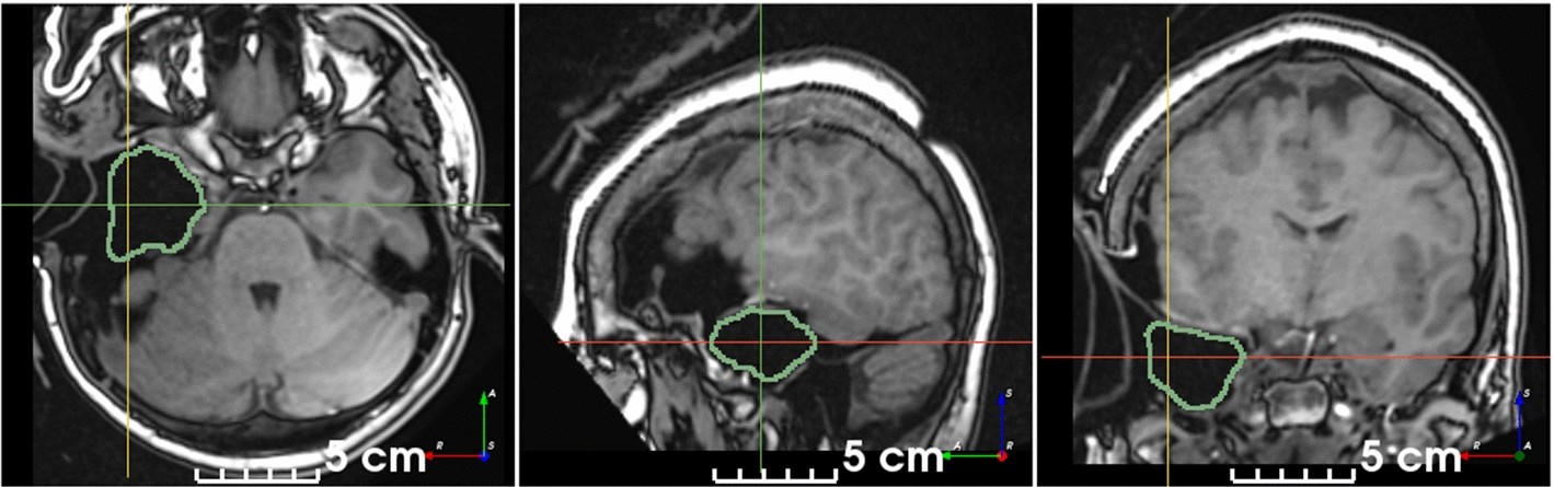 Segmentation of intraoperative MRI