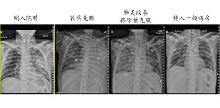 徐先生从入院肺部一片白的状况，到出院时已顺利恢复正常。