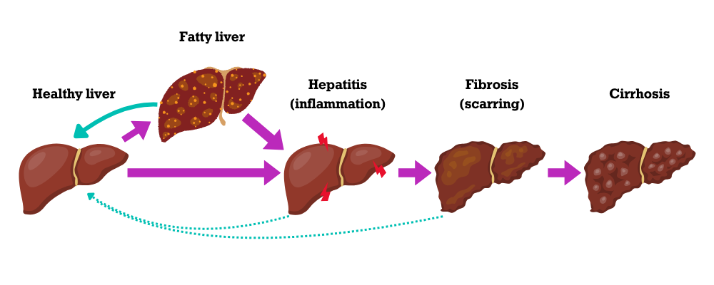 Stages of liver disease, image sourced from the British Liver Trust