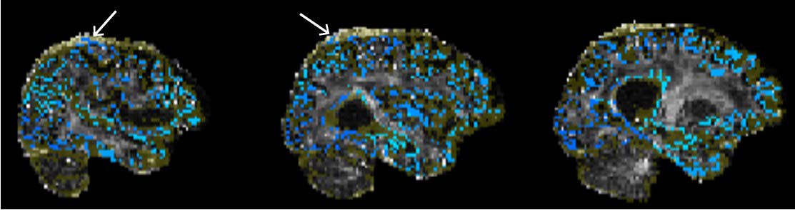 Figure 9. Example of poor quality tractography seed/target placement. The seeds/targets image (blue) as well as the exclusion mask image (yellow) are overlaid on the FA image. White arrows indicate seeds/targets located in the dura.