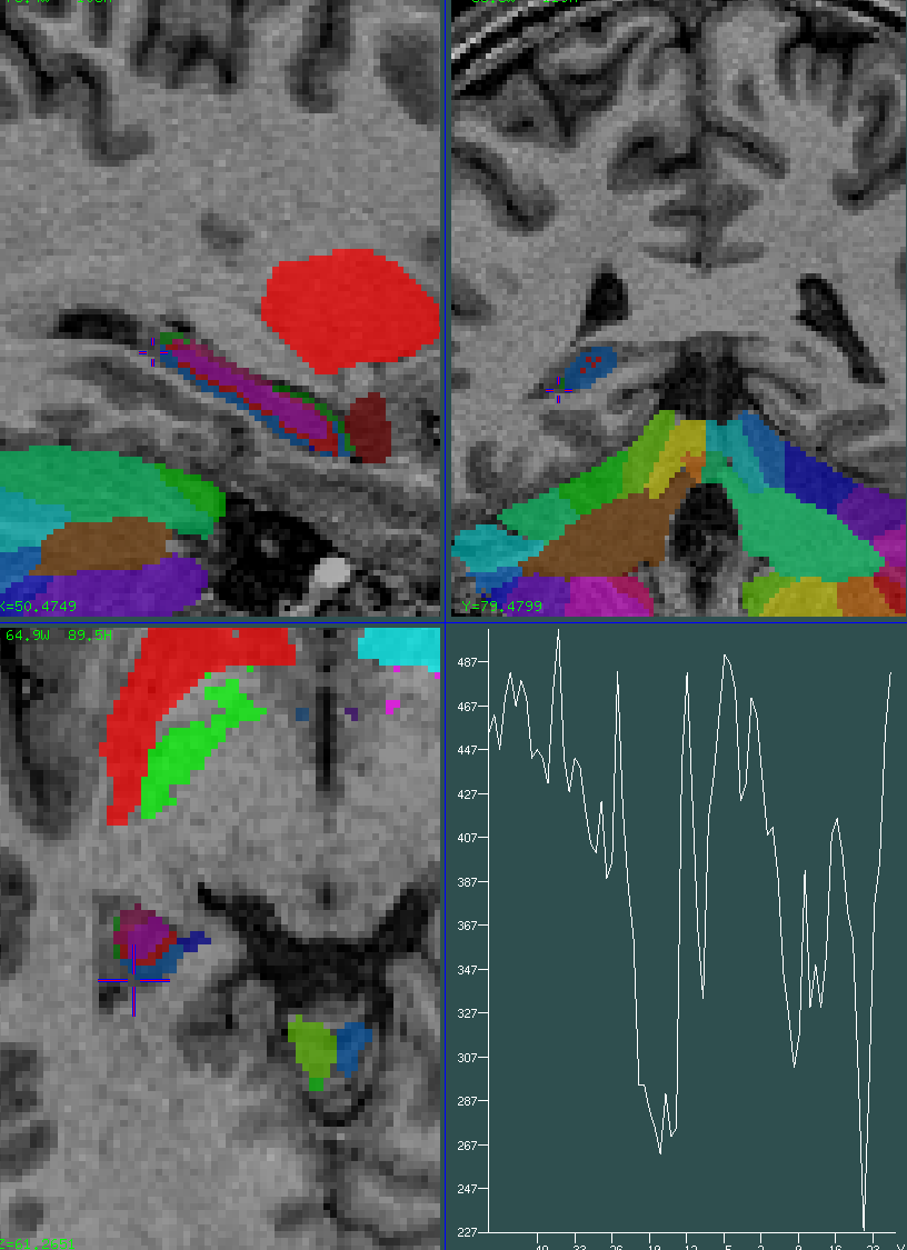 hippocampus 0.75