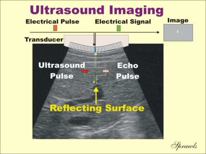 Ultrasound imaging