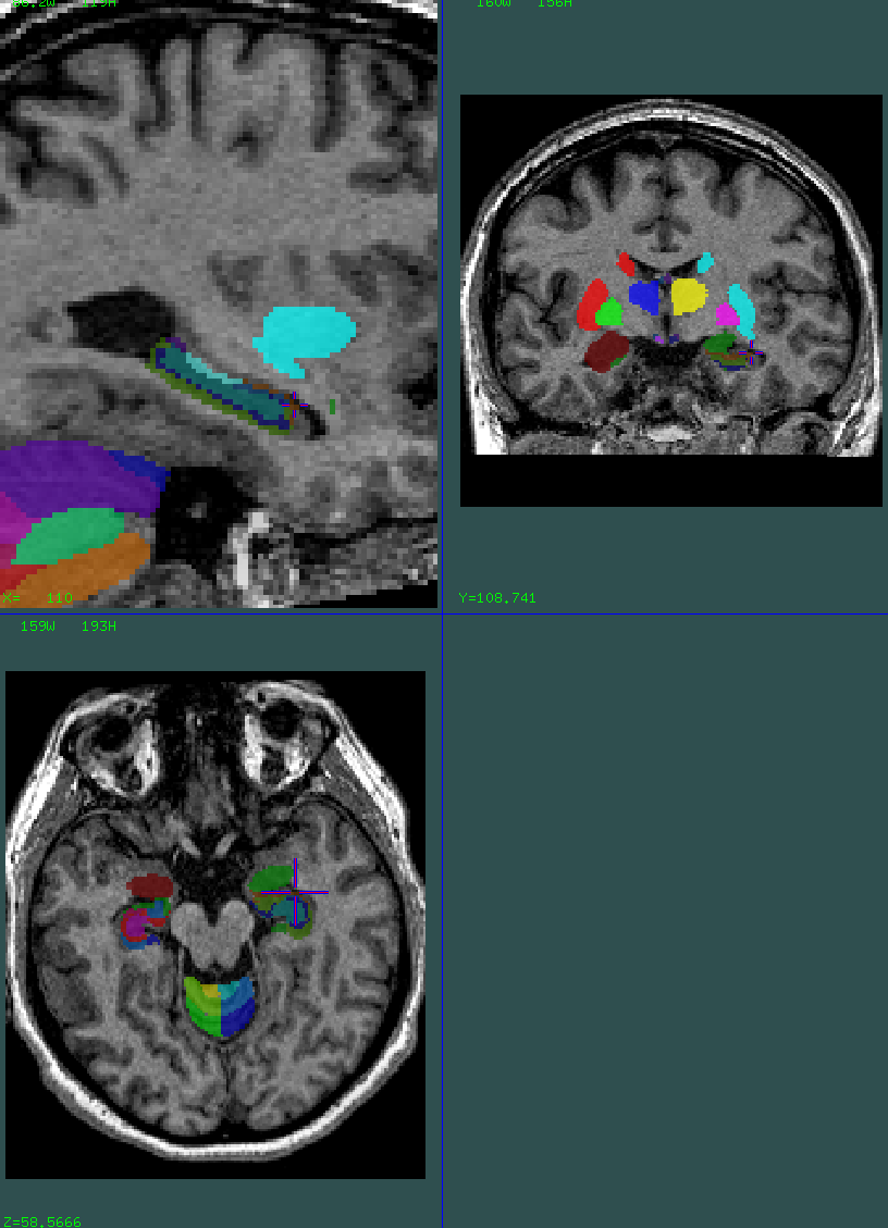 hippocampus head underseg