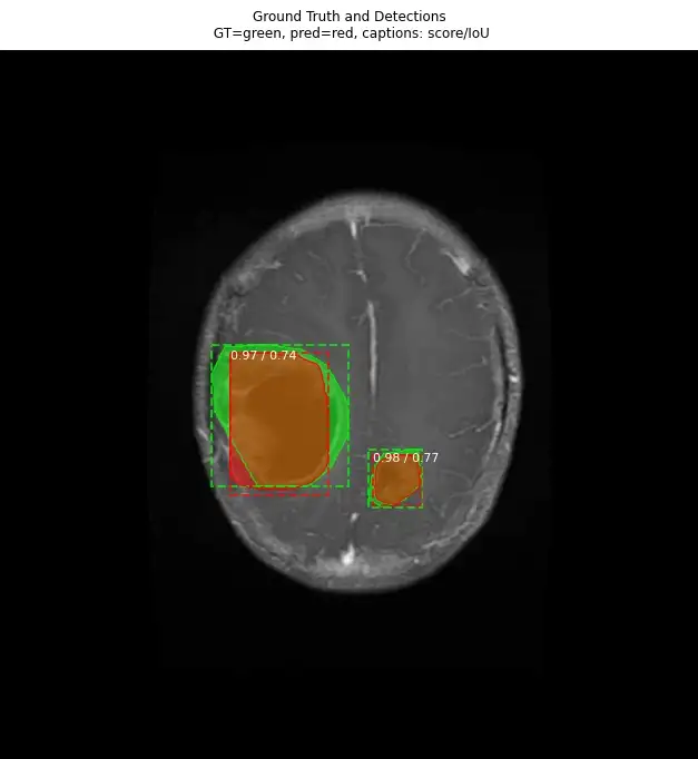 Tumor Detection