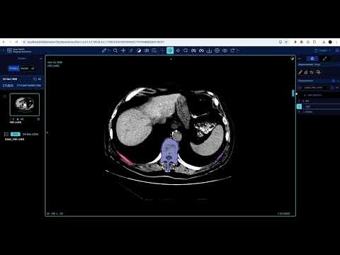 OHIF-SAM2 Demo