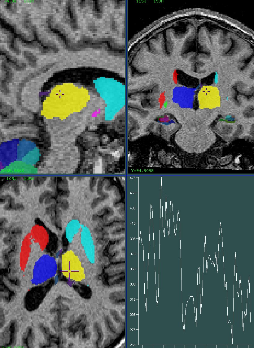 thalamus 1