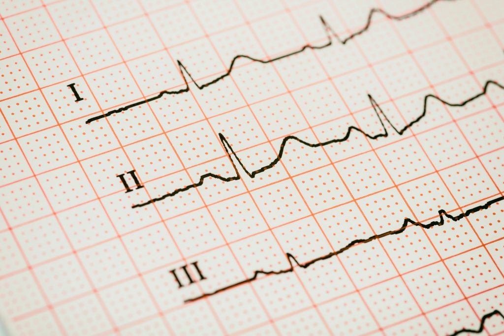 Gambar Elektrokardiogram