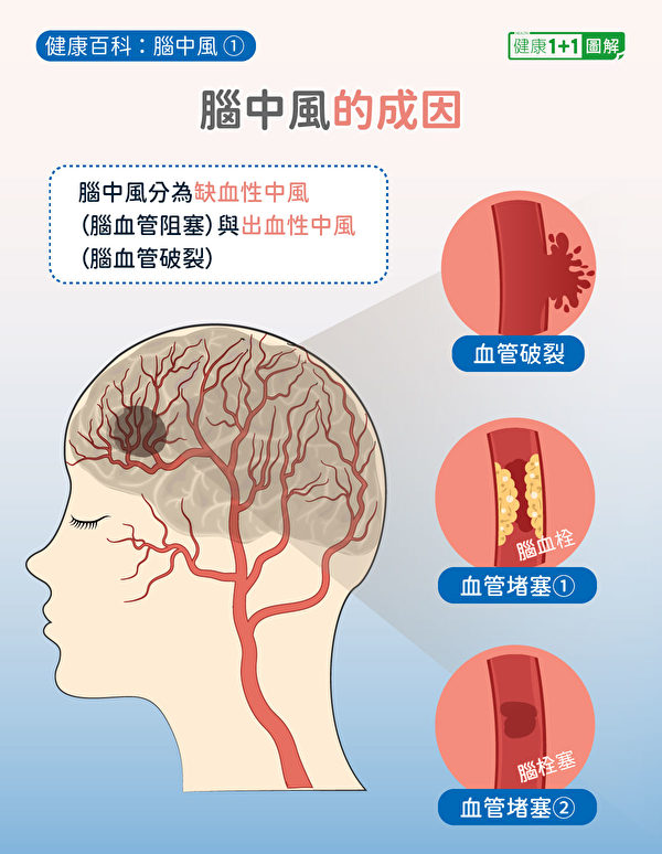 脑中风分为缺血性中风（脑血栓和脑栓塞）以及出血性中风（脑出血）。（健康1+1／大纪元）